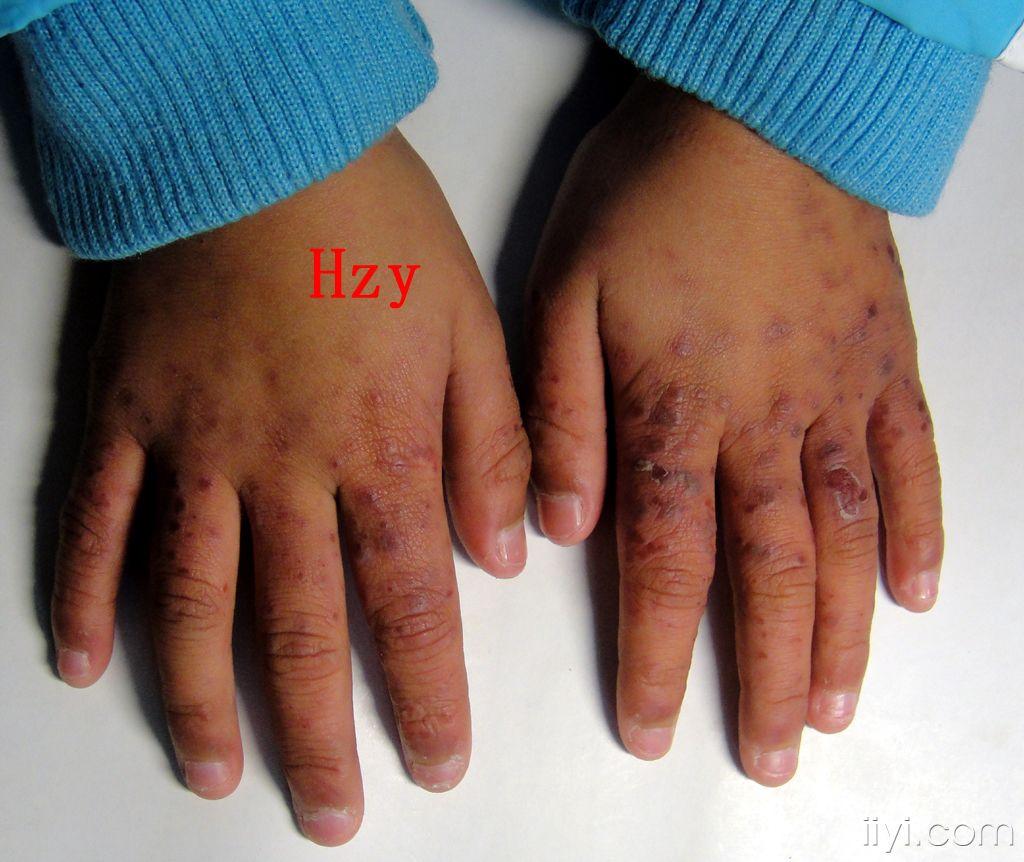 看看小儿的一双手(这种病,这个季节特别多).
