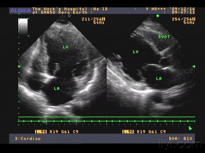 扩张型心肌病彩超图片