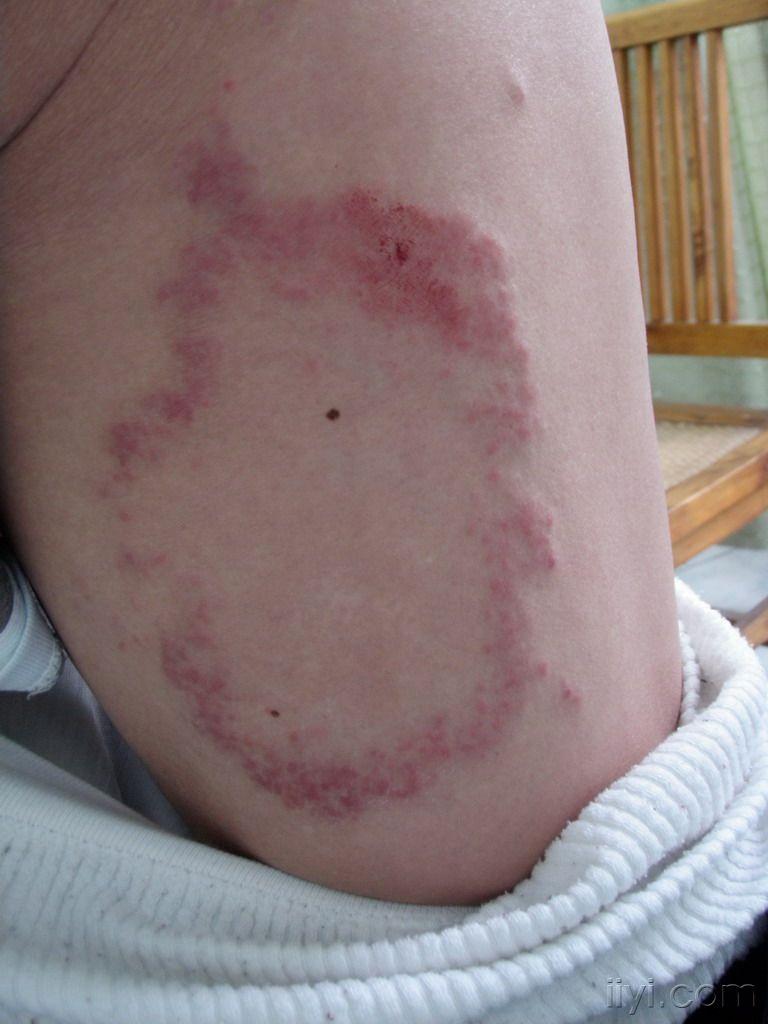 荨麻疹环形红斑图片图片