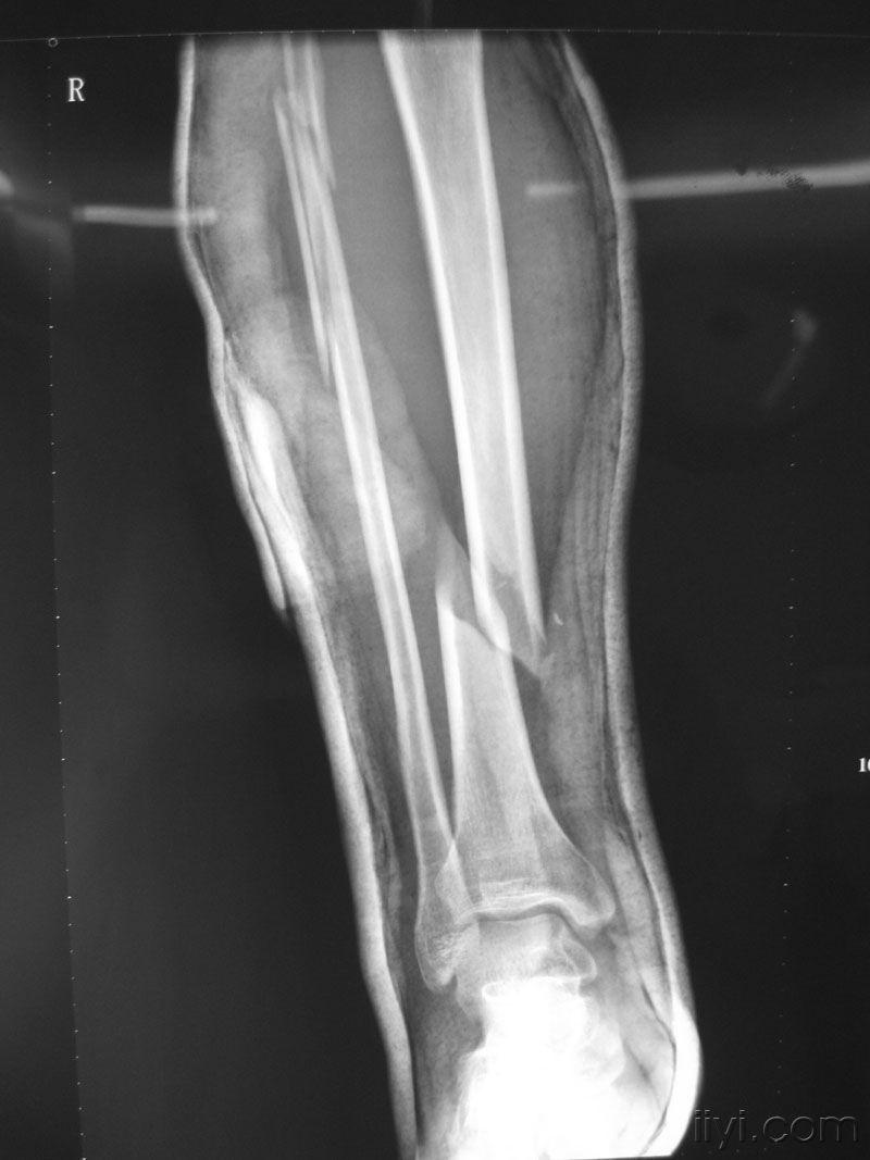 右小腿胫腓骨骨折要多久才能下地走路右小腿胫骨凹陷性骨折