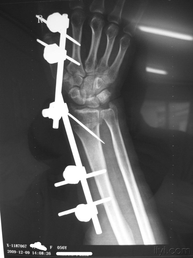 右桡骨远端骨折闭合整复外固定支架