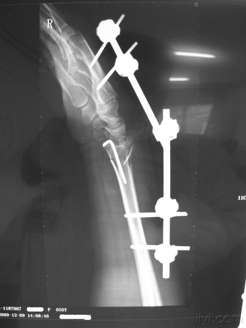 桡骨远端骨折固定术图片