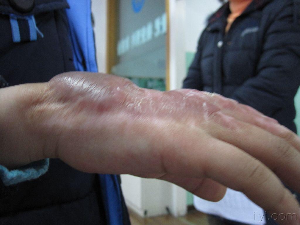 火药烧伤后疤痕增生