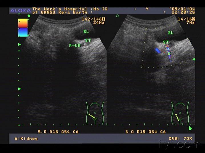 输尿管结石—典型之彩色快闪伪像 超声医学讨论版 爱爱医医学