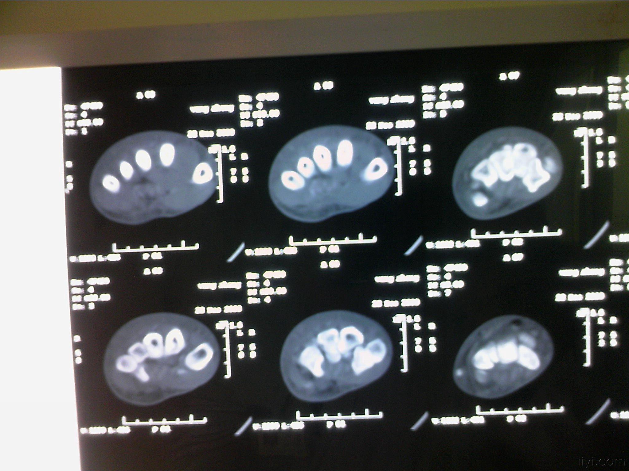 ct片:手机照的不是很清楚.