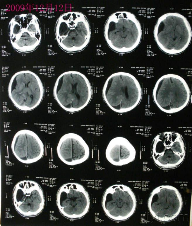 頭部ct討論20091225