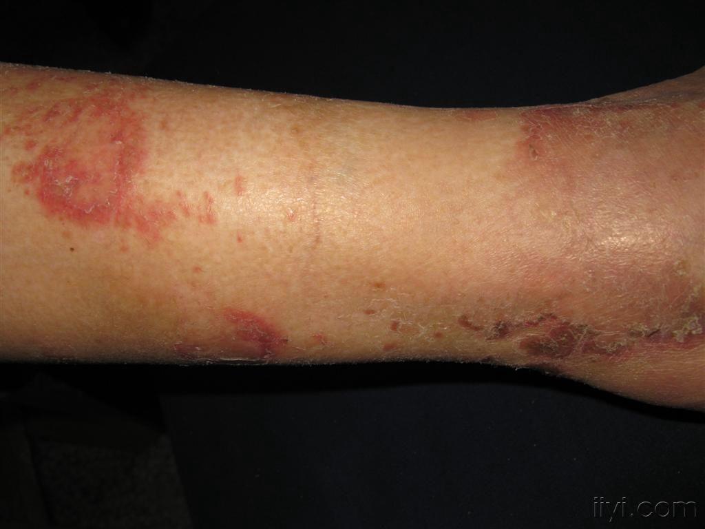 看图识病像体癣吗