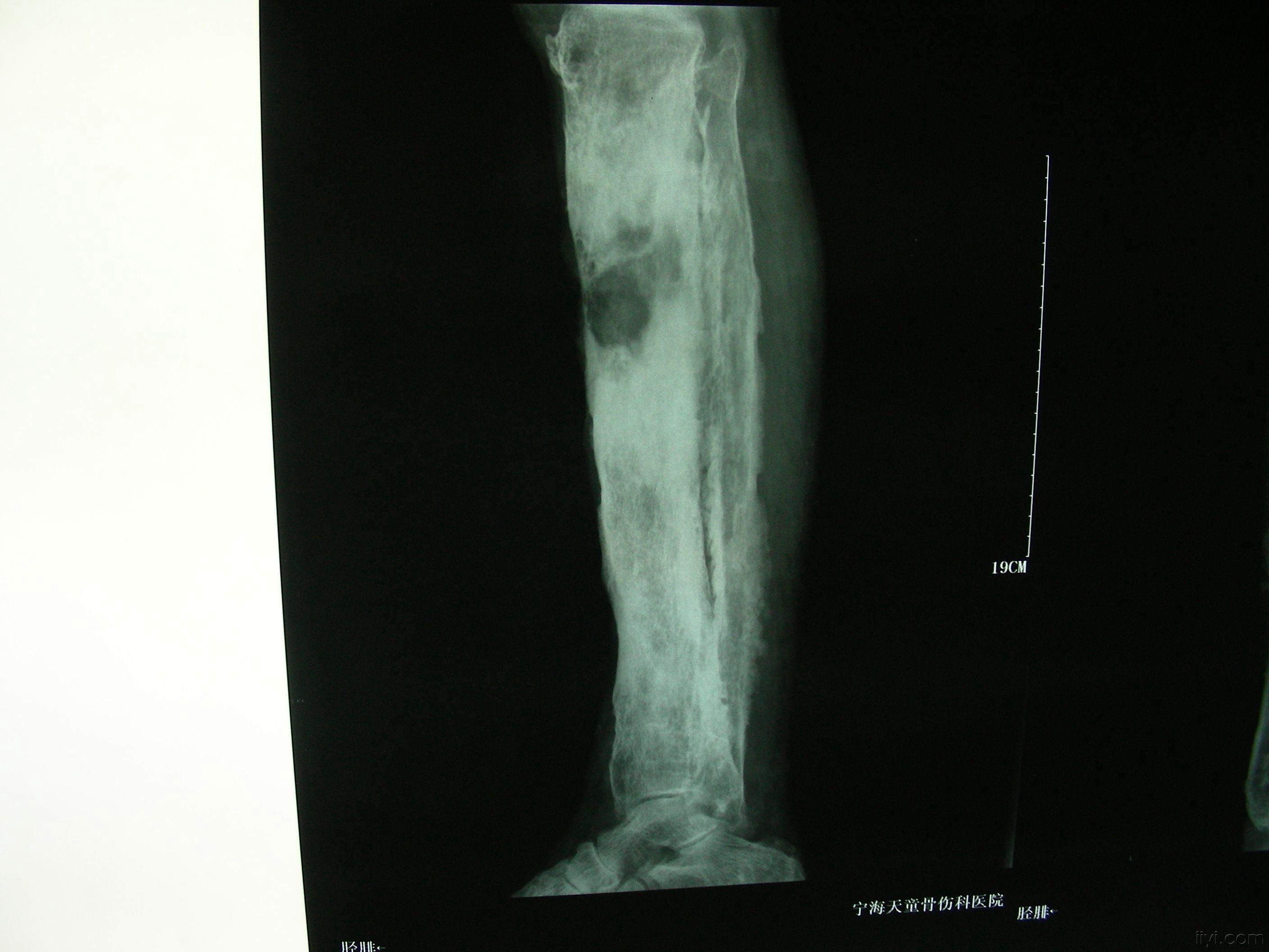 骨髓炎x线图片图片