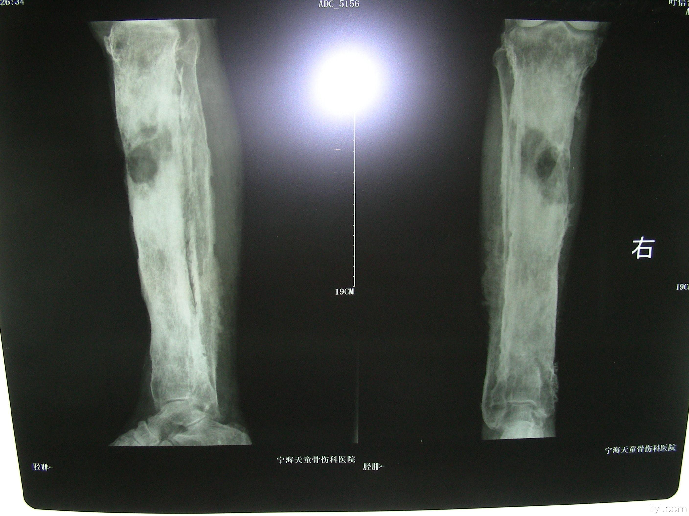 骨髓炎x线图片图片