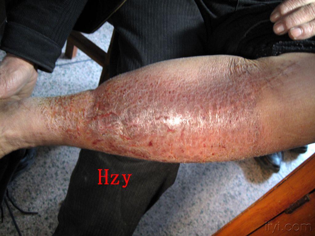 公布答案:接触性皮炎 - 皮肤及性传播疾病讨论版 - 爱爱医医学论坛