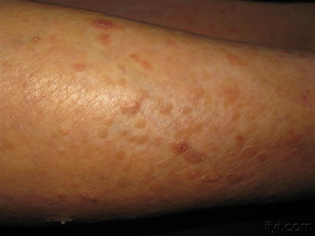 看图识病疣状肢端角化病