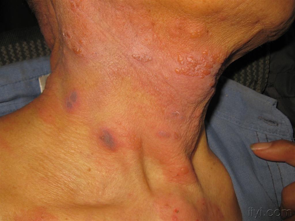 看图识病带状疱疹