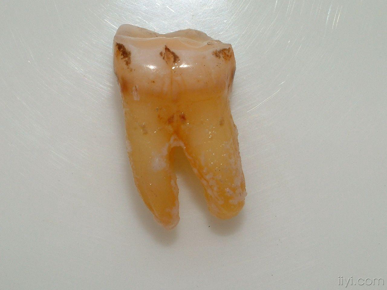 牙根纵裂