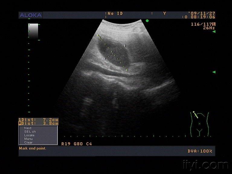 胆囊内胆泥沉积 - 超声医学讨论版 - 爱爱医医学论坛