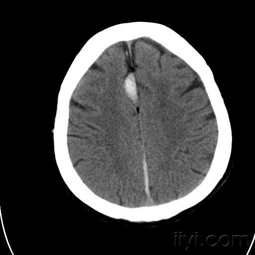 大脑镰硬膜下出血