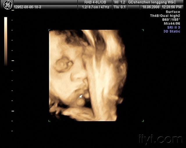 唇裂的图像分享