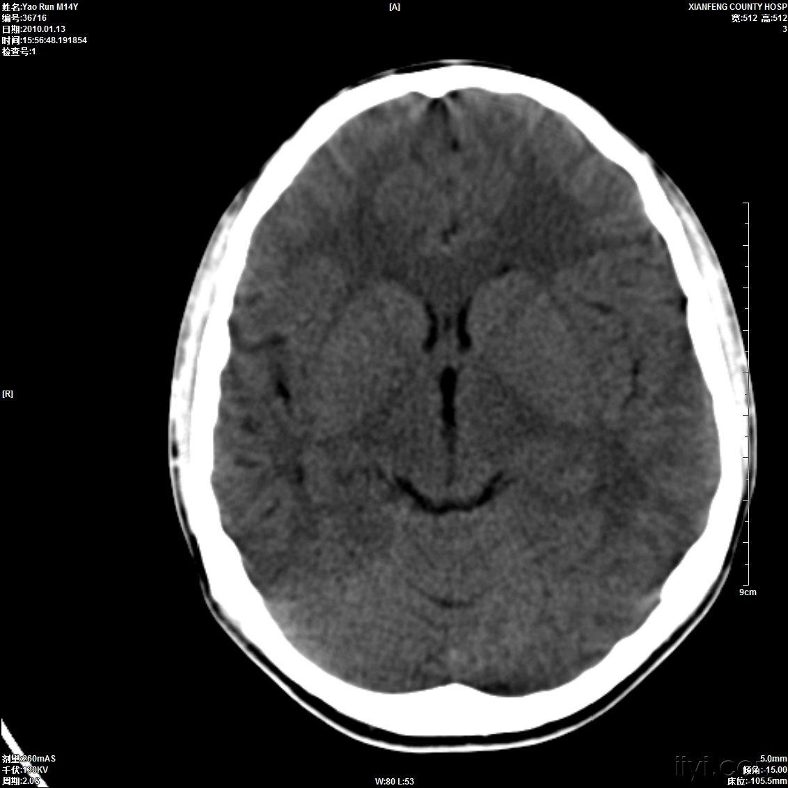 一癲癇患者的頭顱ct