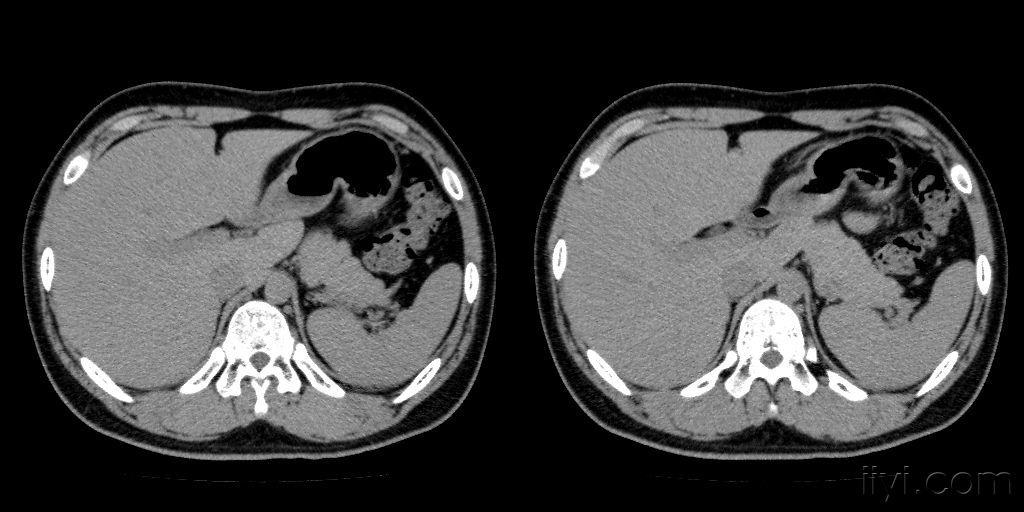 男性16岁因考虑强制性脊柱炎检查发现胰腺饱满