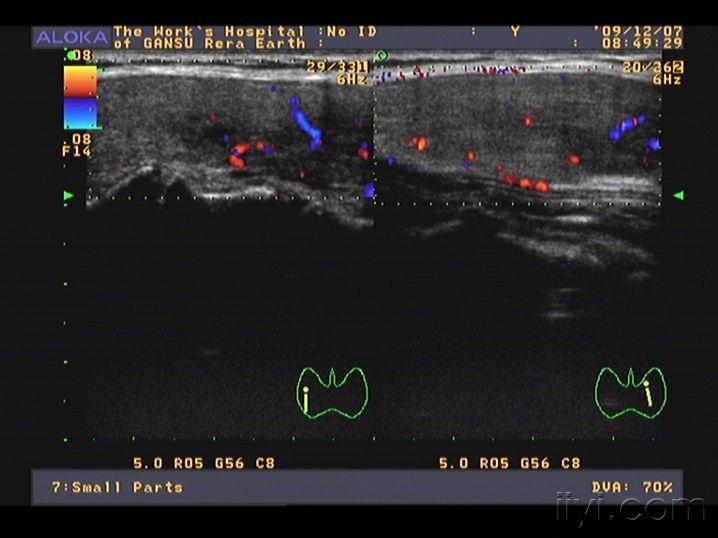 甲亢伴亚急性甲状腺炎 超声医学讨论版 爱爱医医学论坛