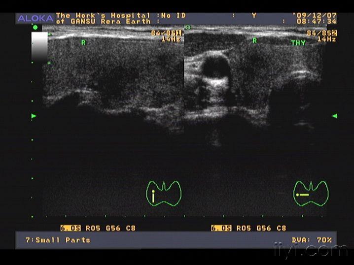 亚甲炎超声表现图像图片