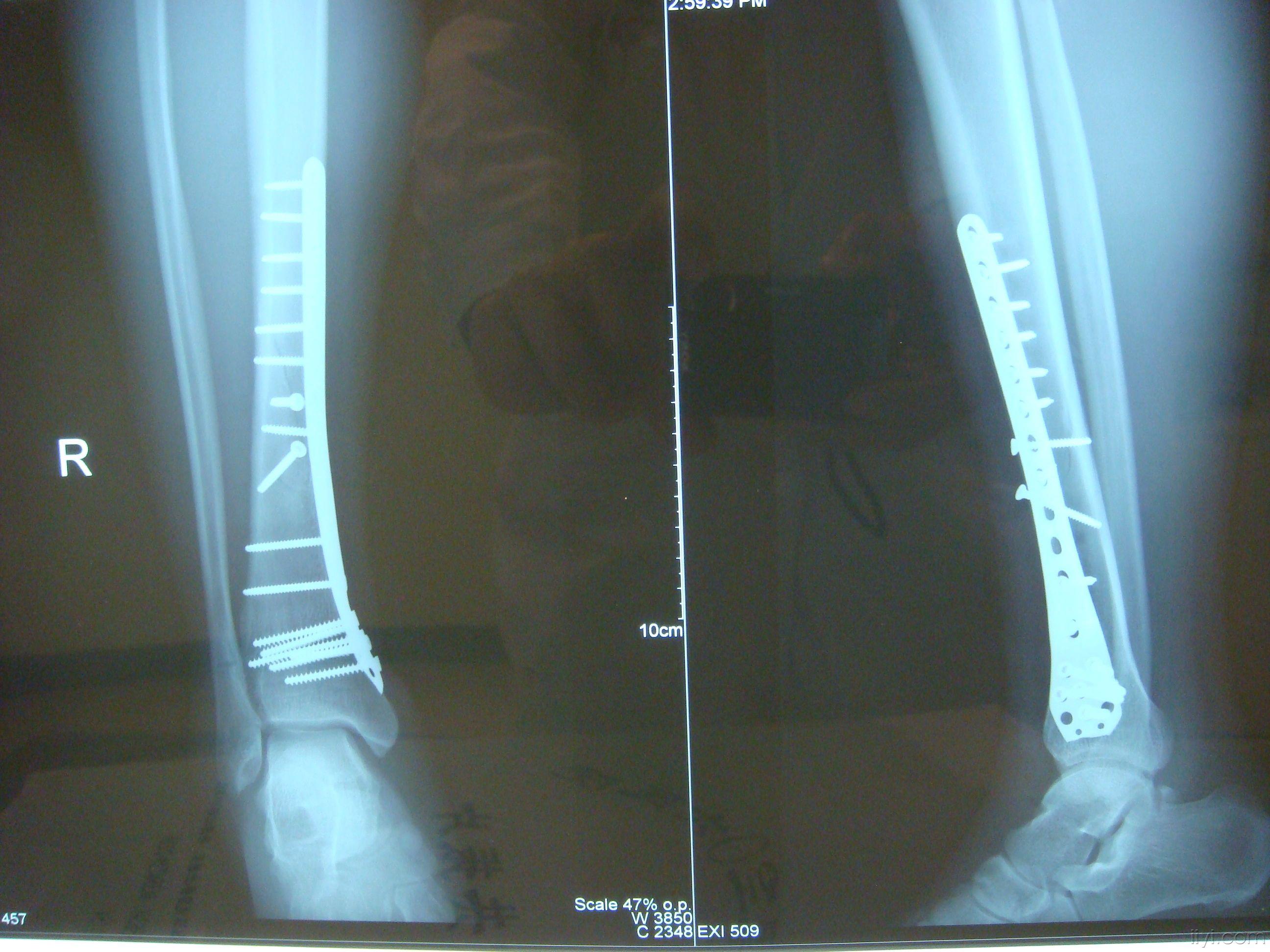 遠 端 腓骨 骨折 位 脛骨近位端骨折の症状・診断・治療 [骨・筋肉・関節の病気]