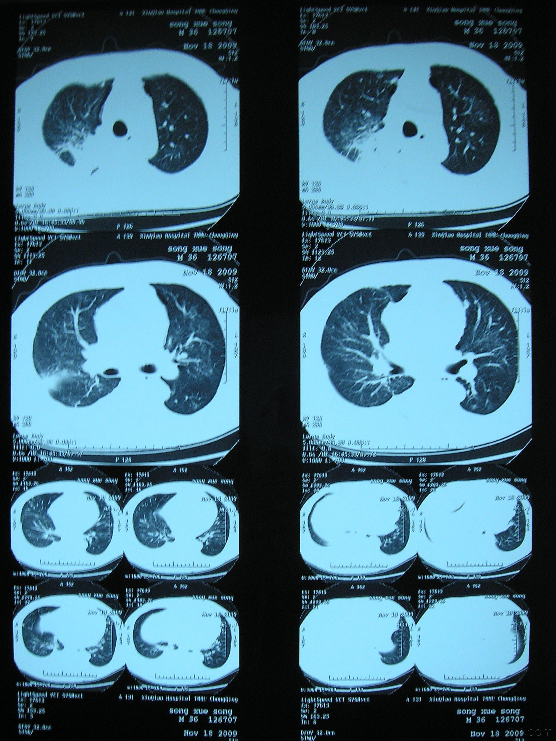 請影像科的老師幫忙分析兩張肺部ct鮮花送不好意思多次傳才成功