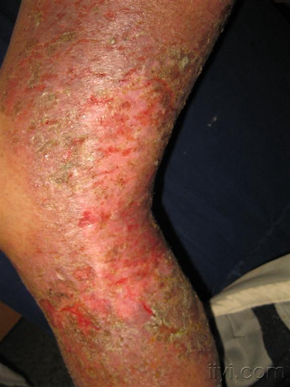 右下肢大面积湿疹瘙痒2年