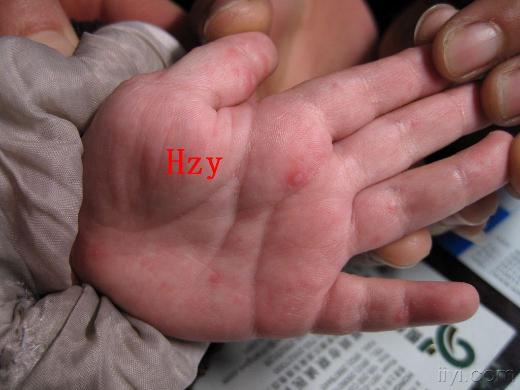 患儿两手两足及臀部皮损二天公布答案手足口病