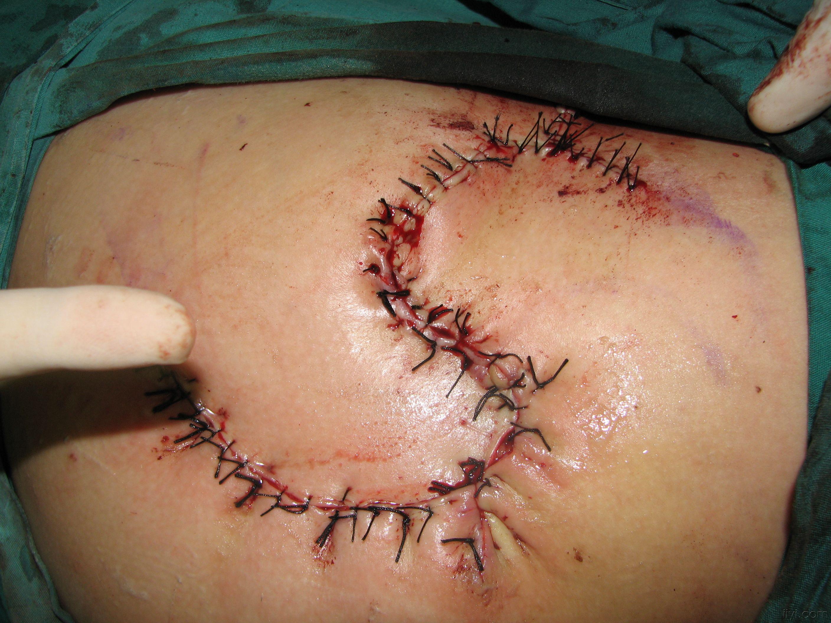 邻近皮瓣修复臀部创面