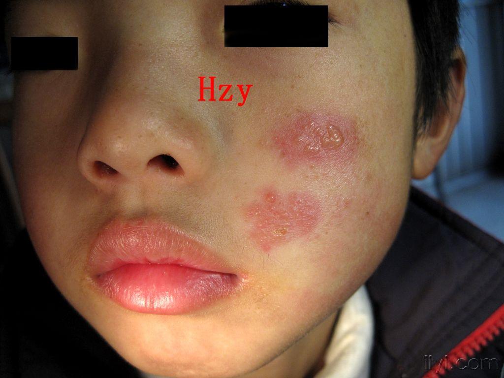 看该患者左脸部皮损是单纯疱疹还是带状疱疹公布答案单纯疱疹