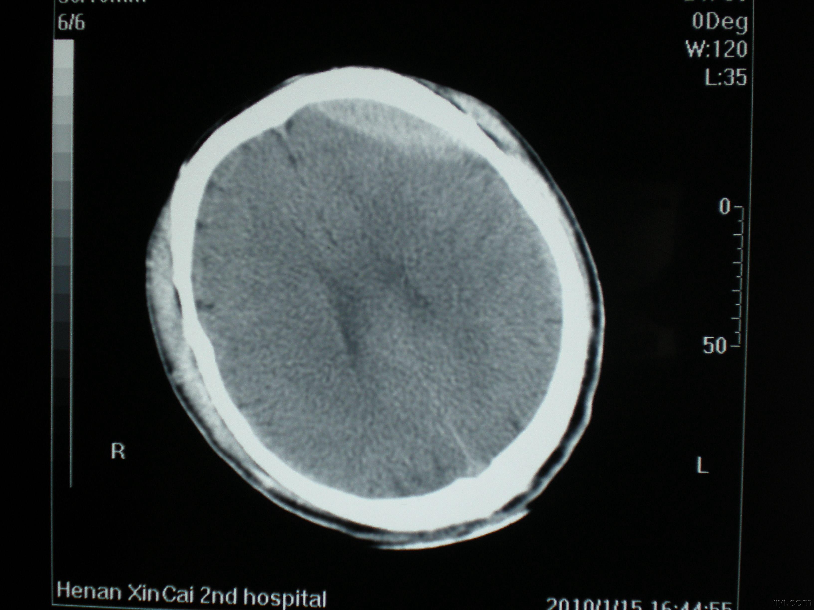 硬膜下出血ct图图片