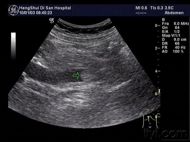 胆管癌超声图片