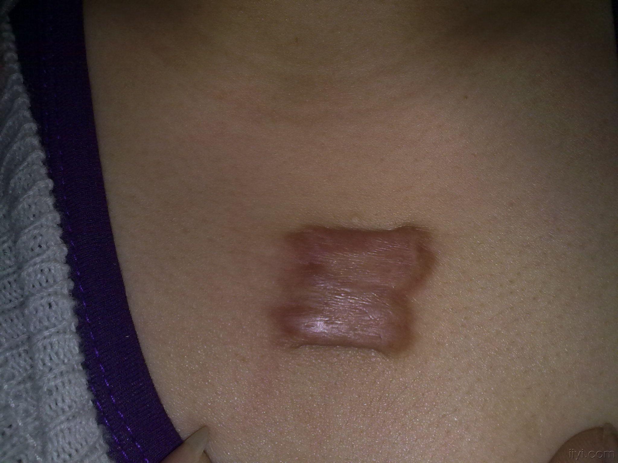 手术疤痕修复的最佳效果什么样 100122224896e9d8c89dfadf5c.jpg