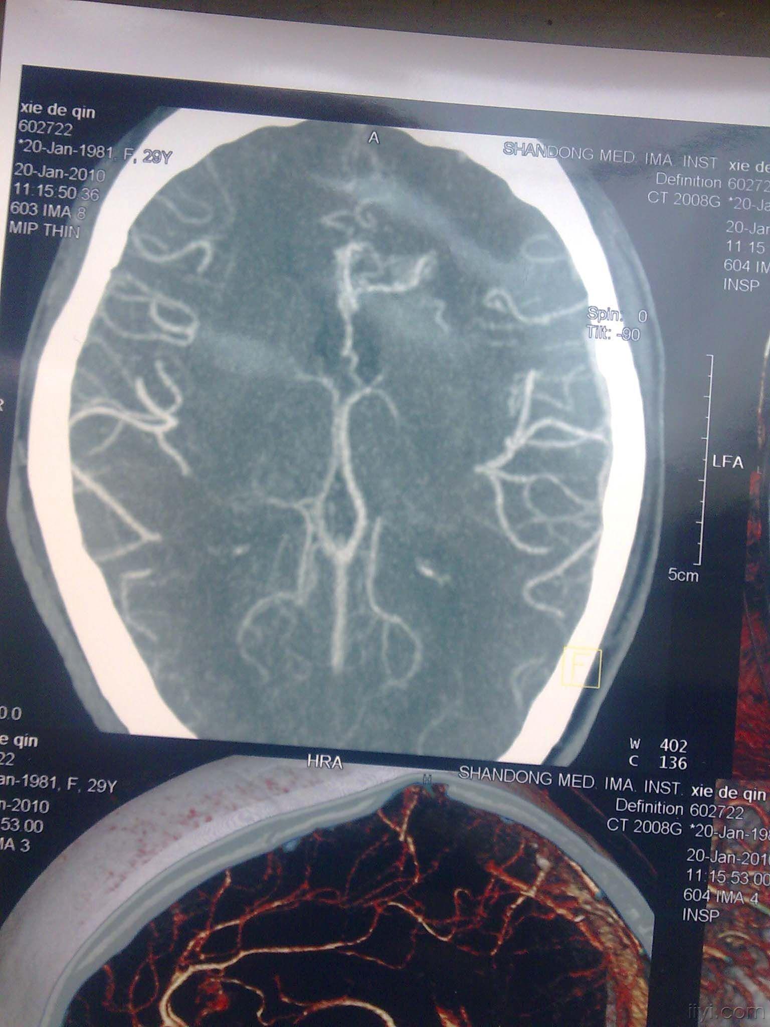先天性脑血管畸形图片图片