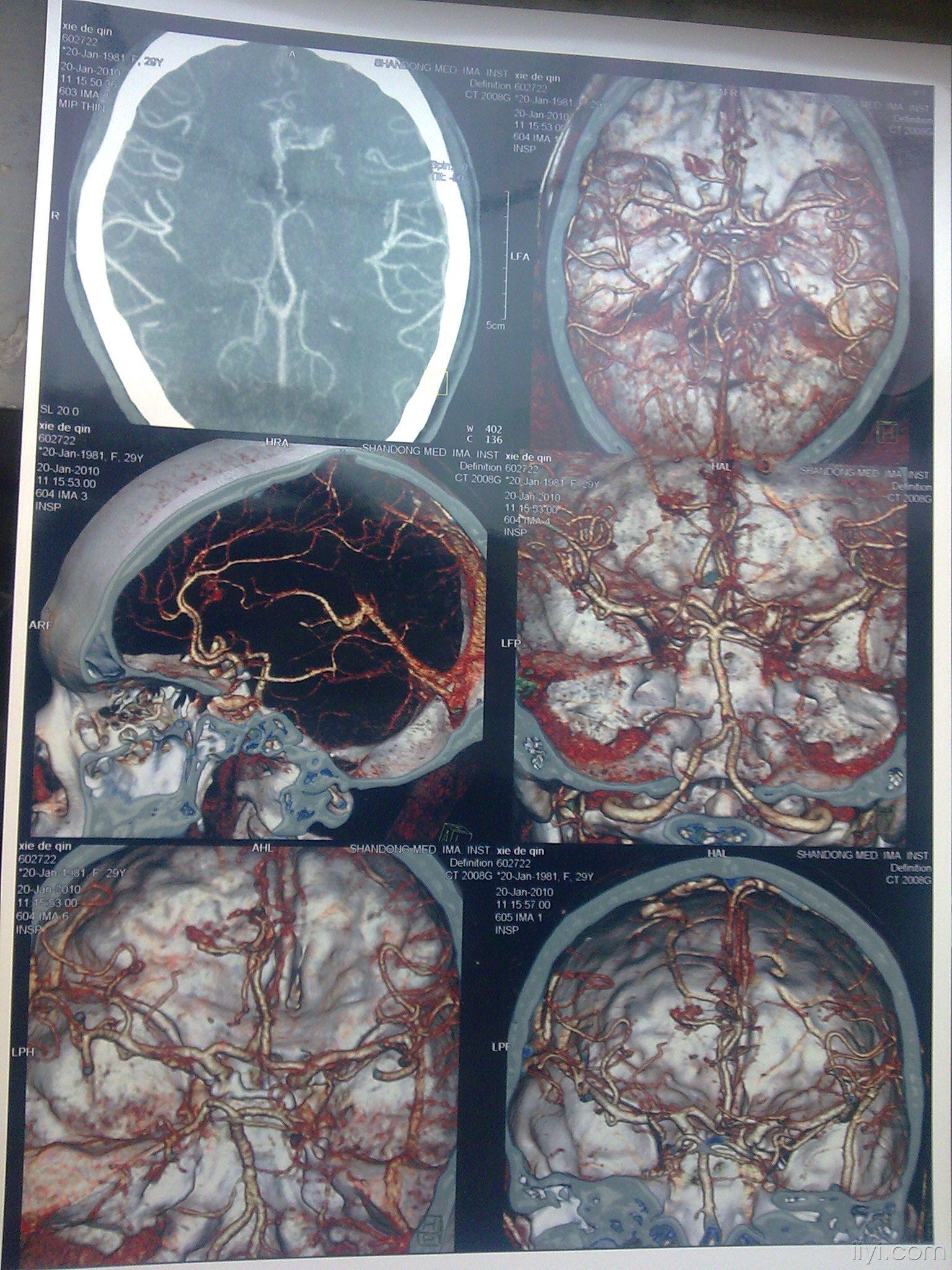 先天性脑血管畸形图片图片