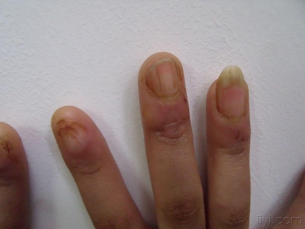 扁平苔癣的甲损害