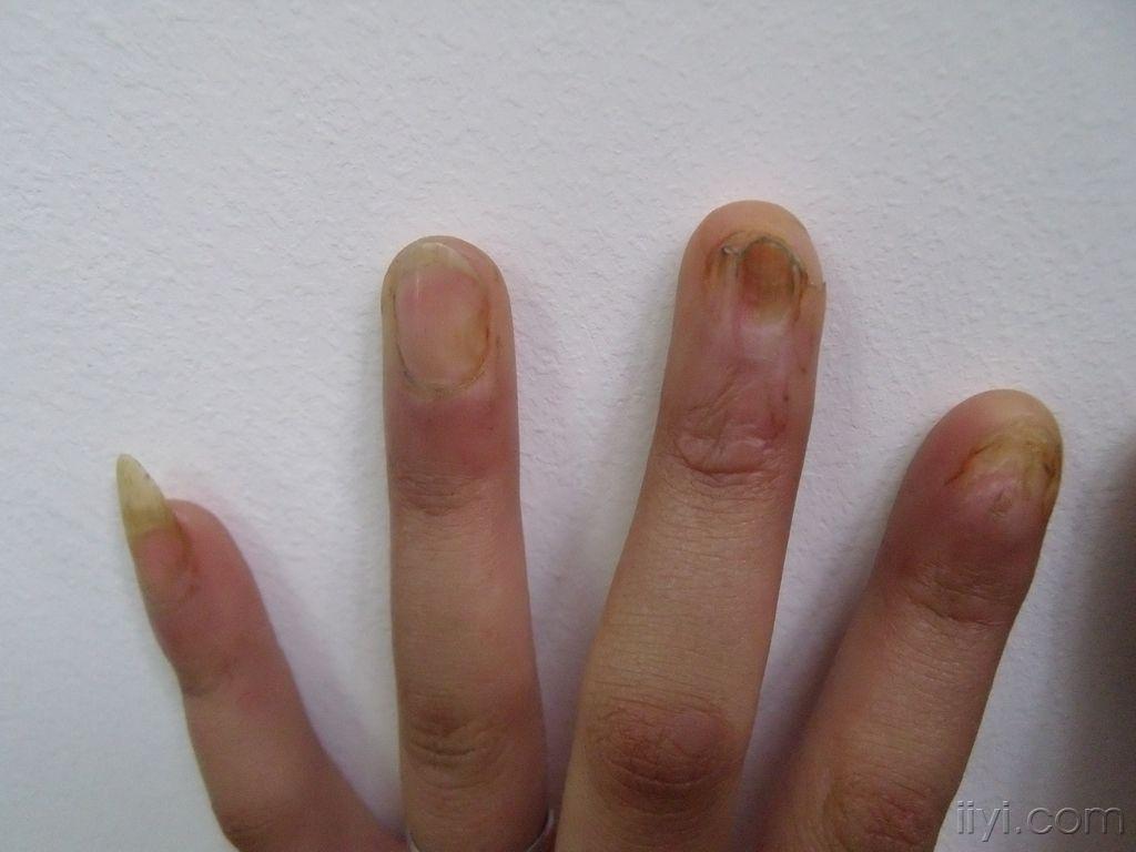 扁平苔癣指甲初发图片图片