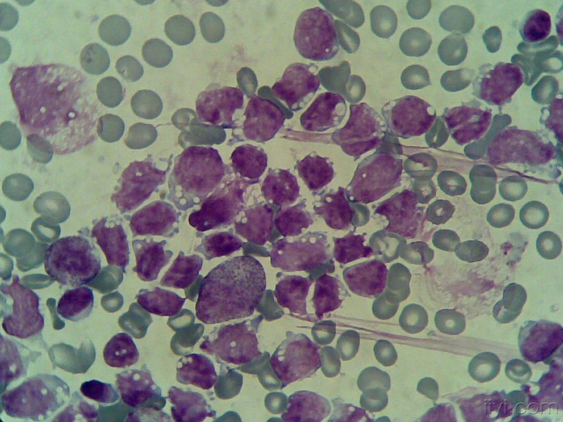 淋巴细胞浸润代表什么 间质大量淋巴细胞浸润