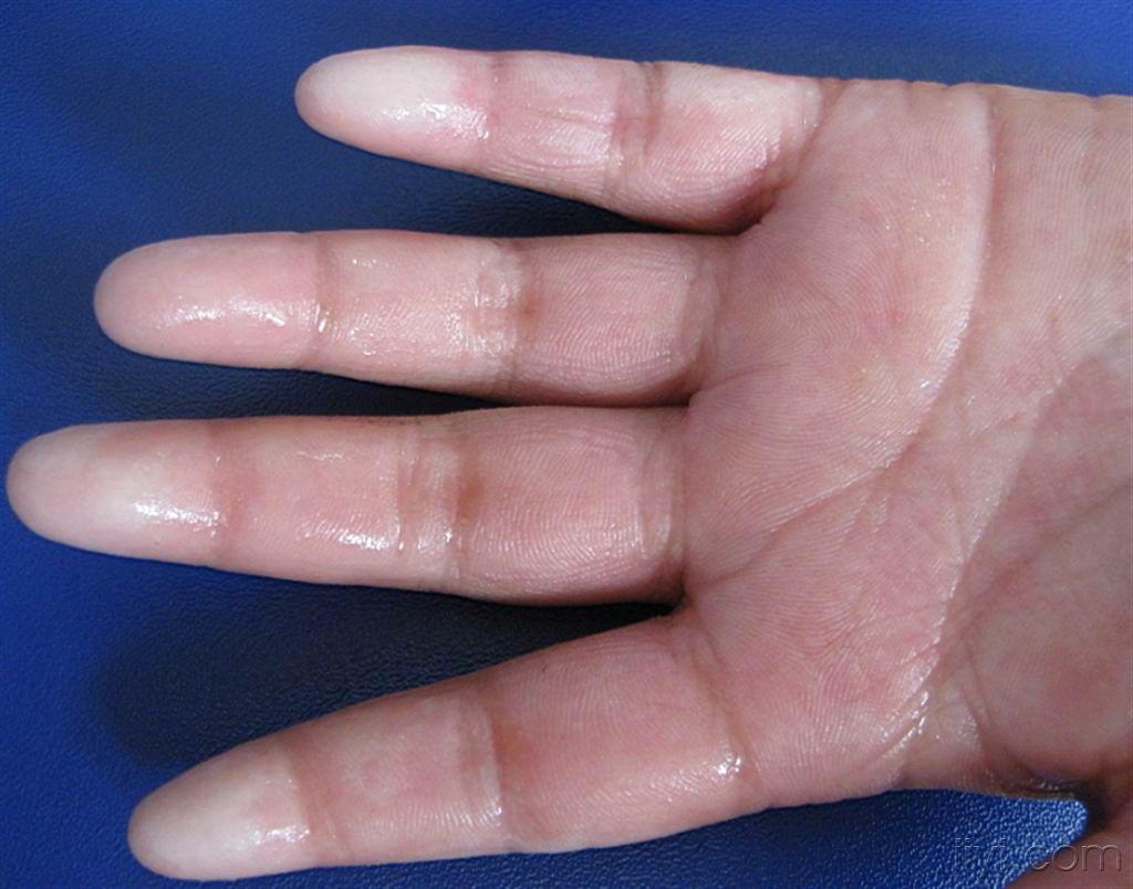 典型图片多汗症