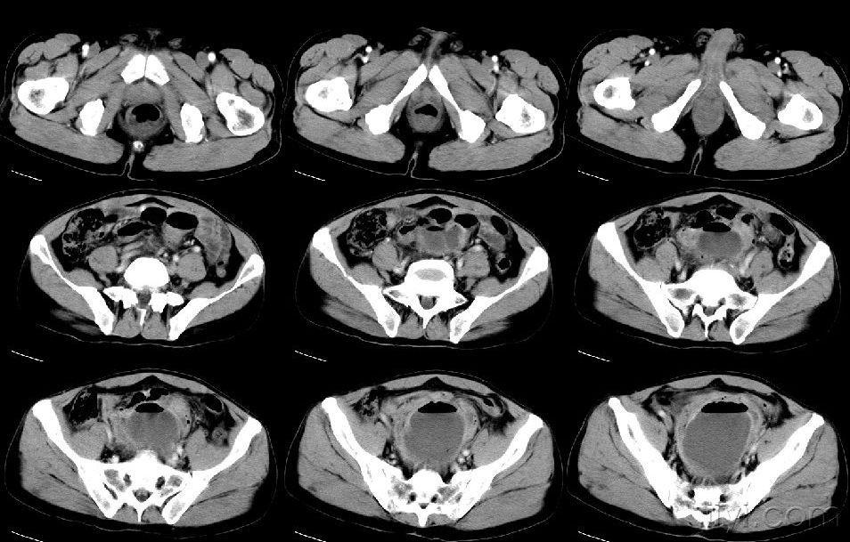 盆腔占位/ct/公布结果/100128
