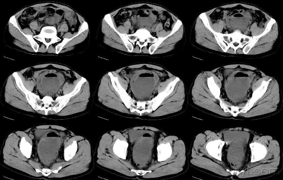 盆腔ct平扫图片