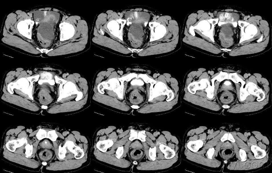 盆腔佔位/ct/公佈結果/100128