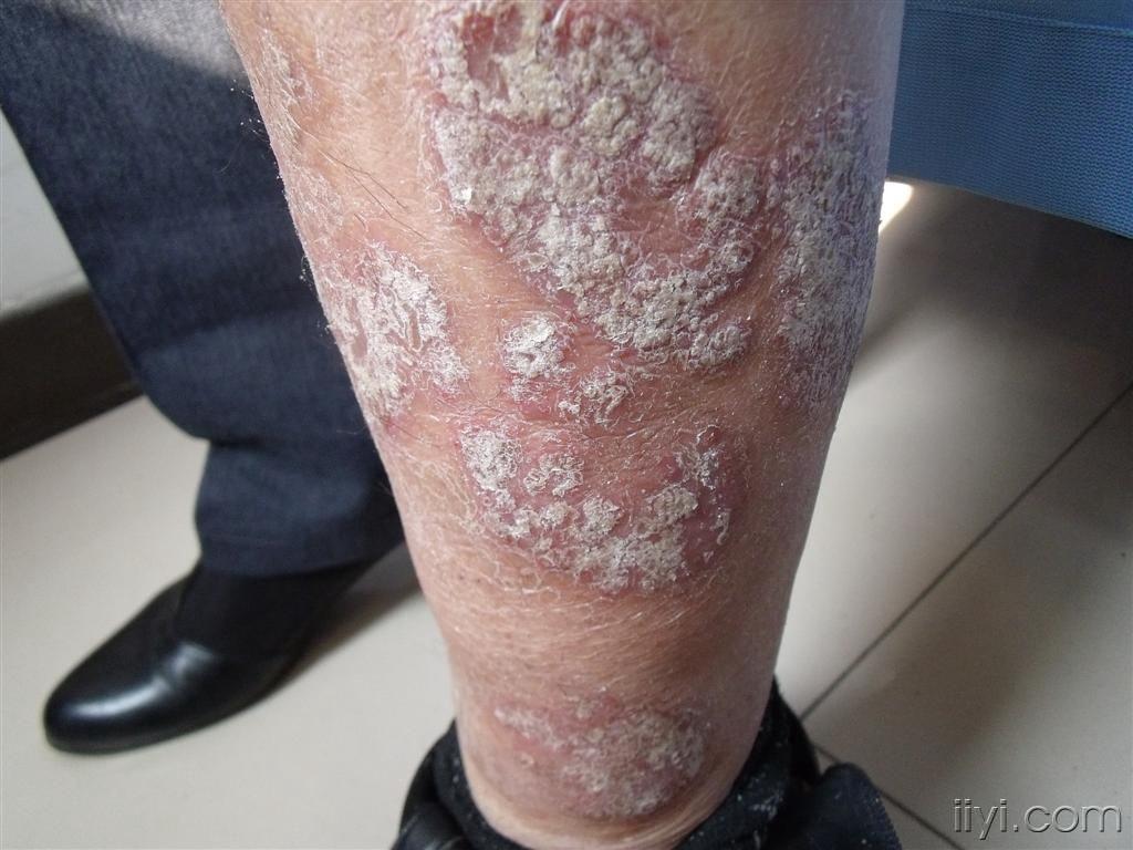 银屑病(手背)和下肢 - 皮肤及性传播疾病讨论版 - 爱爱医医学论坛