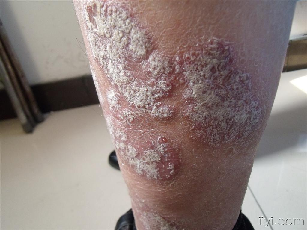 银屑病(手背)和下肢 - 皮肤及性传播疾病讨论版 - 爱爱医医学论坛