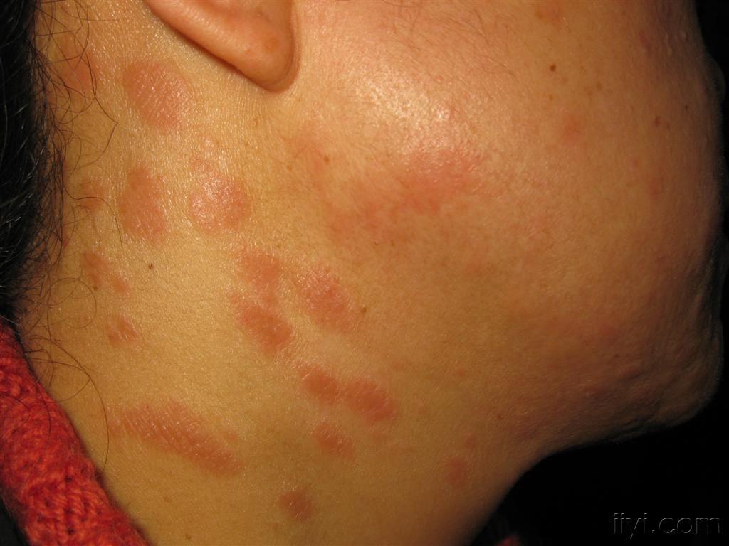 左氧致颈面部皮疹 - 皮肤及性传播疾病讨论版 - 爱爱医医学论坛