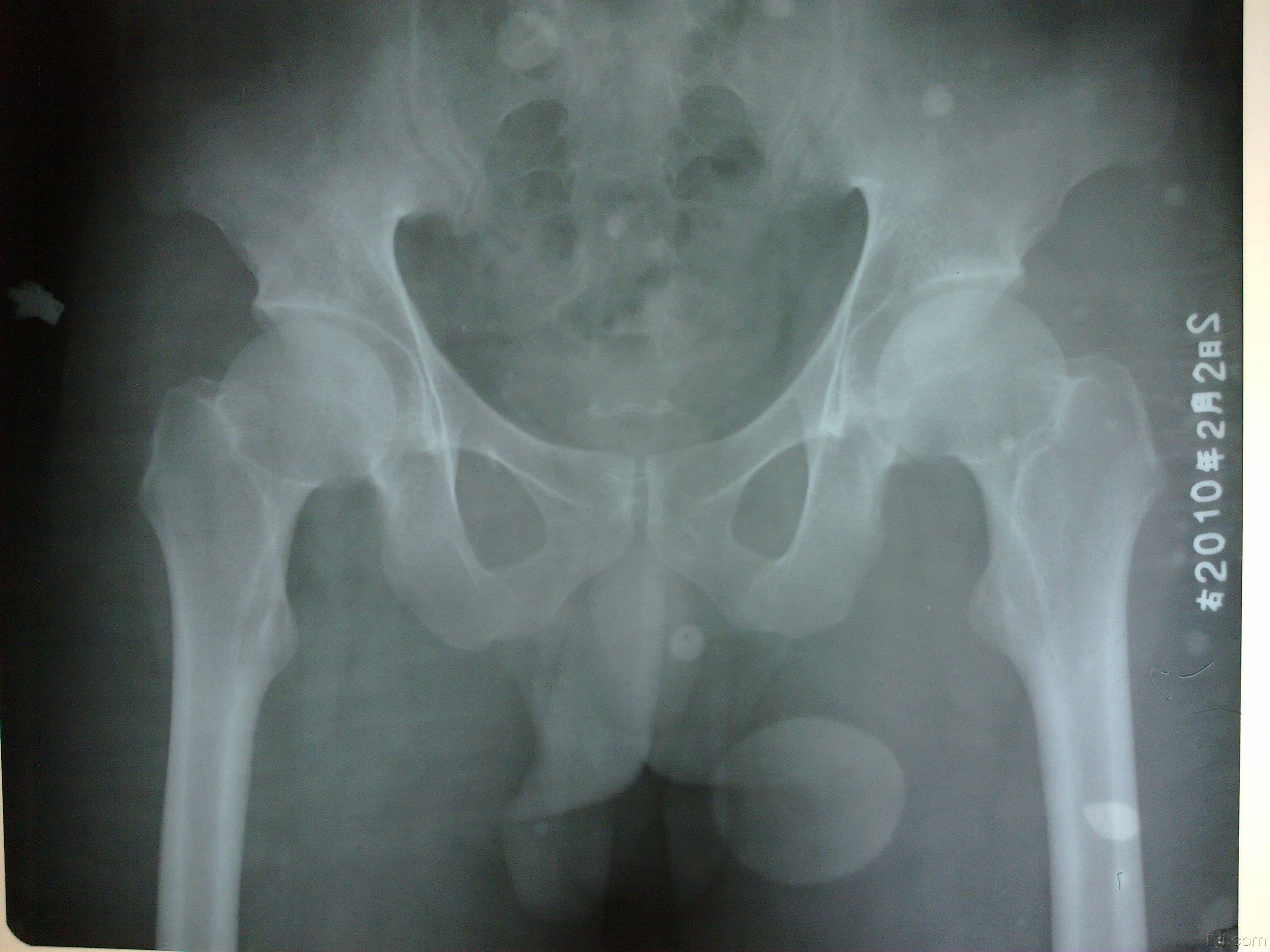 请各位前辈看个骨盆平片
