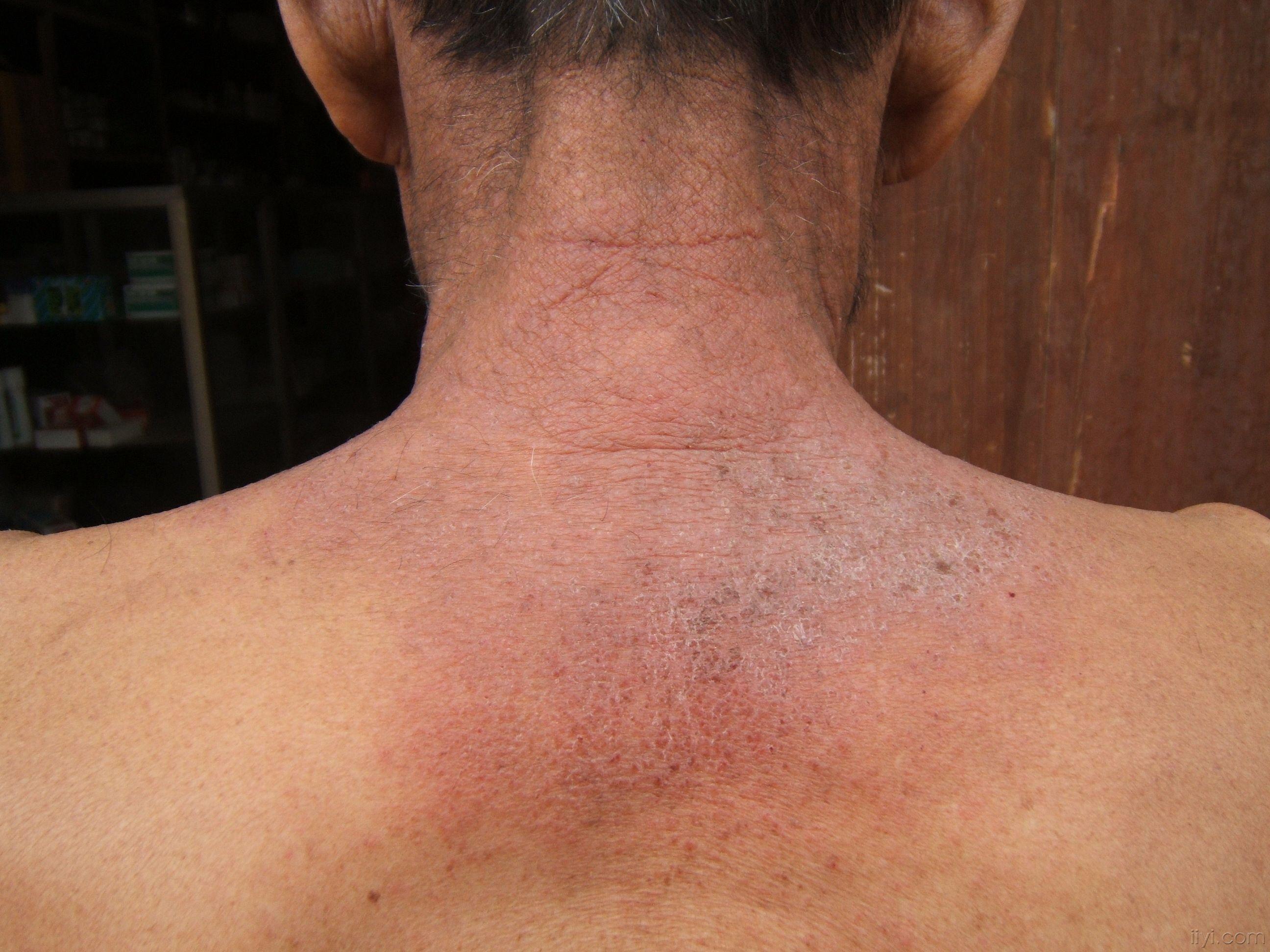 精彩高清图片,不容错过--照片太大(萤) - 皮肤及性传播疾病讨论版