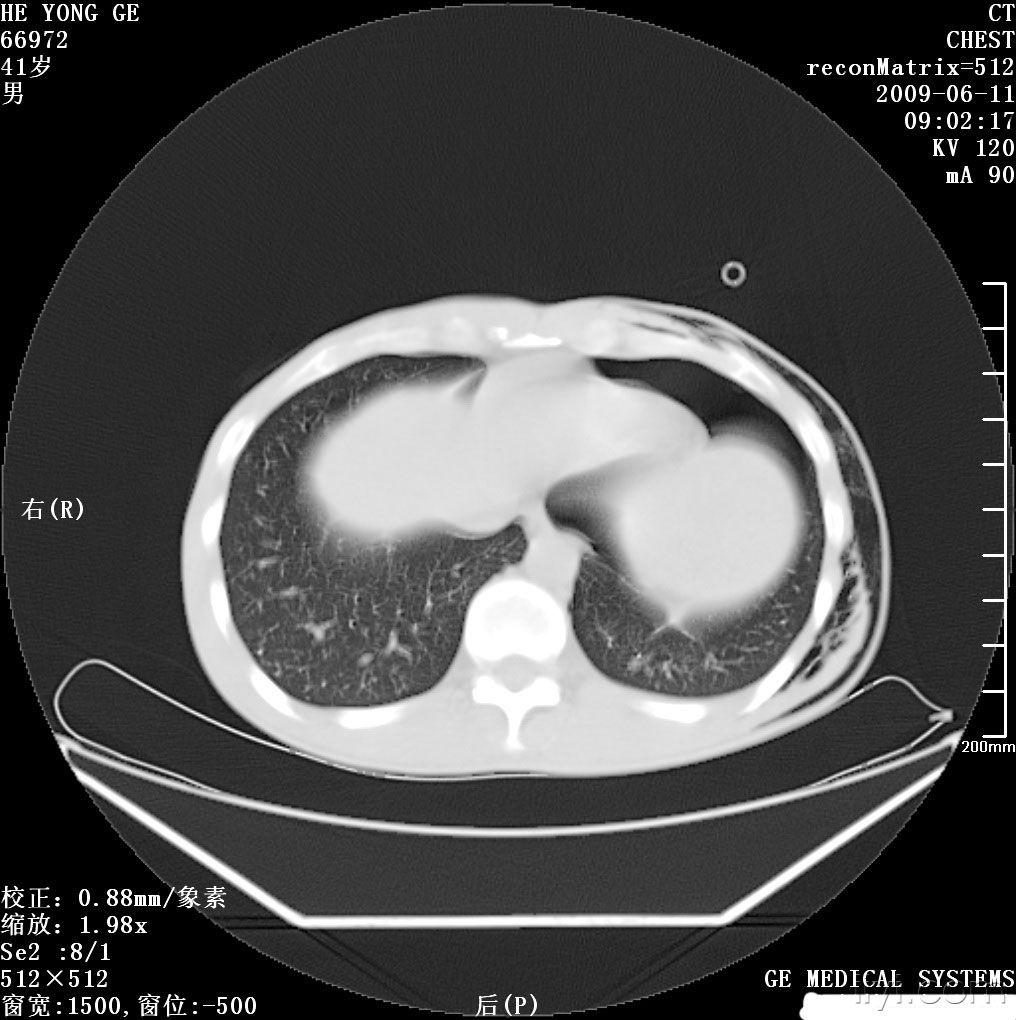 大家來看看這個胸部ct 發表下意見 - 醫學影像學討論版 - 愛愛醫醫學