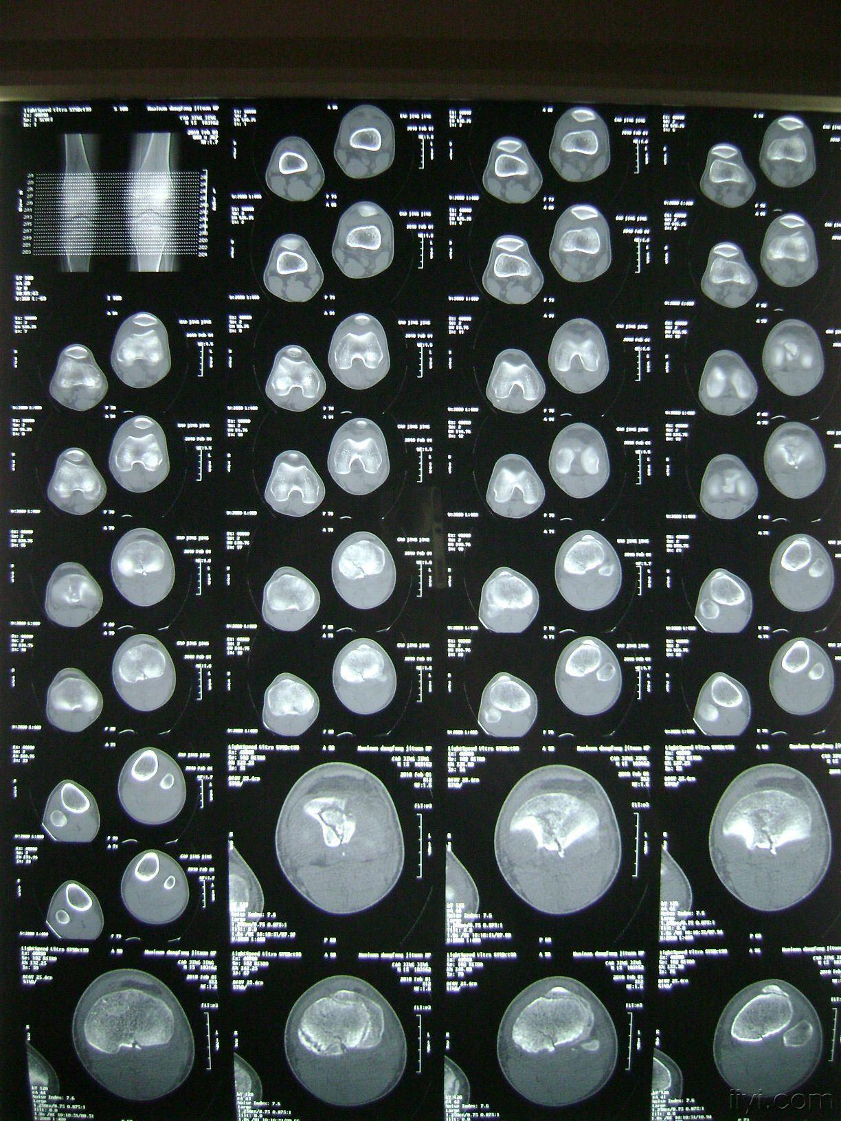 左膝关节胫骨平台骨骺损伤4型