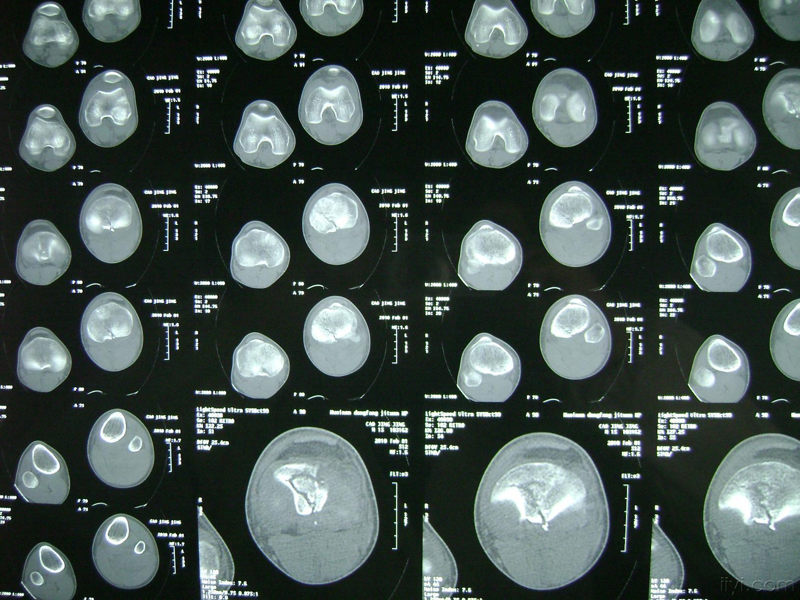 左膝关节胫骨平台骨骺损伤4型